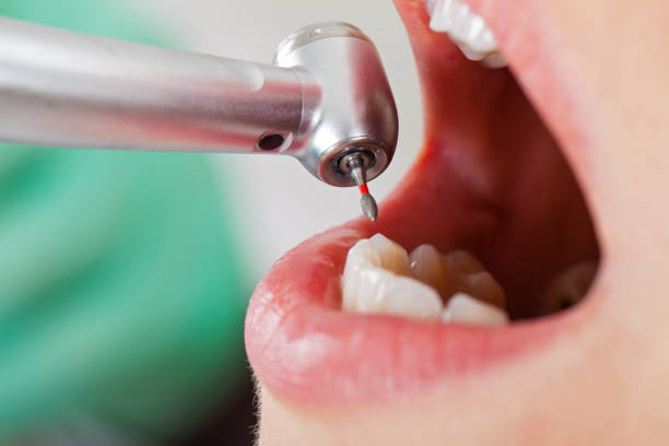 Best Emergency Dentist for Lost Fillings or Crowns in Pataskala, OH